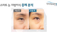스마트 눈 지방이식-증례분석