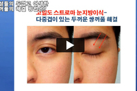 남성들의 두껍고 어색한 쌍꺼풀, 다중겹 쌍꺼풀 해결 방법