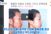 얼굴지방이식 실패 안하는 방법은?