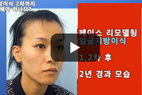 지방이식 2차 꼭 해야 하나?-지방이식 2차 필요성-얼굴지방이식-풀페이스 지방이식-페이스 리모델링