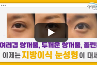 여러겹 쌍꺼풀, 두꺼운 쌍꺼풀, 졸린 눈을 쌍수없이 교정하는 지방이식 눈성형-스마트 눈지방이식