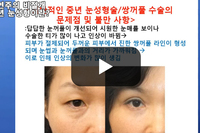 수술 한 티 안나는 자연주의 비절개 눈성형, 쌍꺼풀 수술-라인강화법-수술 전후사진-중년 눈성형-상안검수술-꺼