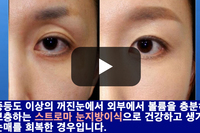 꺼진눈 교정에 가장 효과적인 방법은? 눈지방이식? 아니면 눈지방재배치? 그 정답을 알려드립니다.