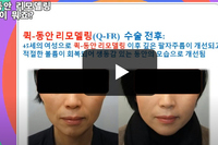 [퀵 동안 리모델링 리프팅] 효과 좋은 특수실 리프팅과 얼굴필러 그리고 보톡스