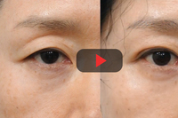 50대 이상 중년 동안성형 