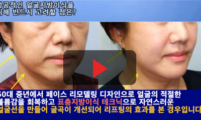 40대 이상에서 성공적인 얼굴지방이식을 위해 반드시 고려할 점!!
